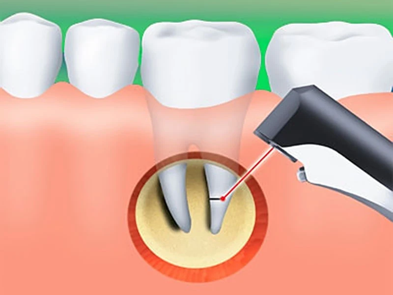 Illustration of root-end microsurgery on a tooth
