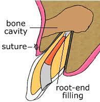 Sealed root tip after root-end surgery