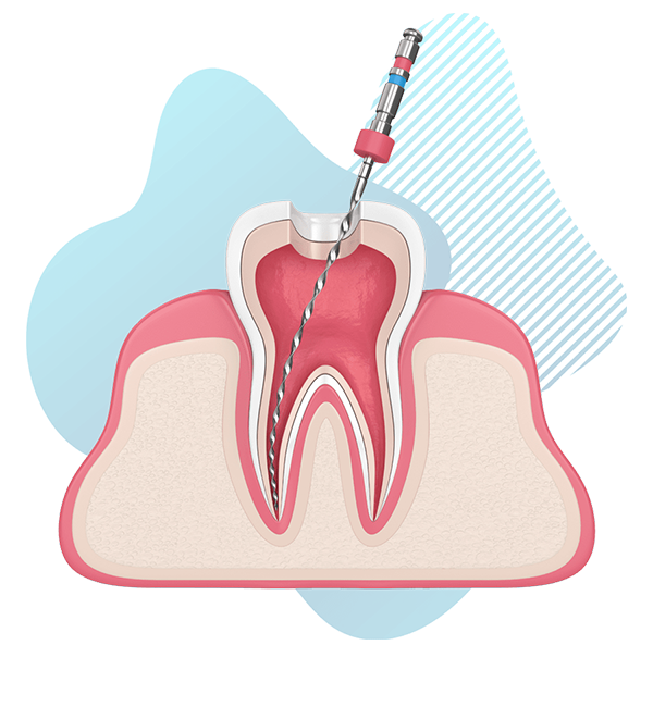 Endodontic instruments used to clean root canal spaces