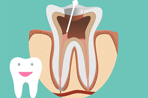 Root canal treatment in progress