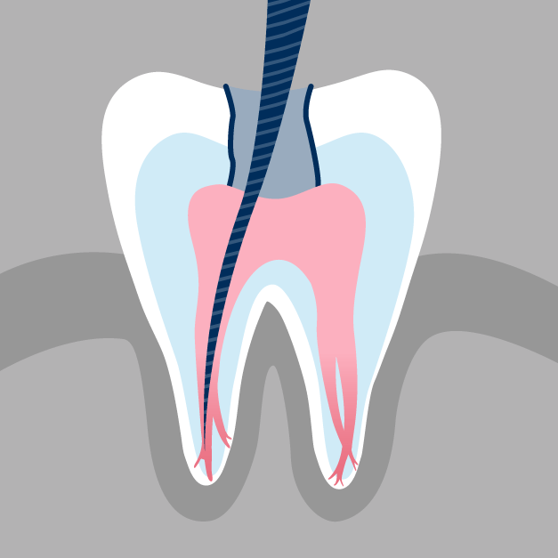 Illustration of a root canal file inside a tooth